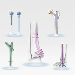 Tornillo de Bloqueo Distal y <span class=keywords><strong>Proximal</strong></span> para Clavo Intramedular de Titanio - Product Image 2