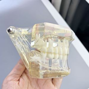 Modèle de restauration d'implant dentaire M2001, modèle de pathologie dentaire en silicone médical transparent pour exposition scientifique médicale - Product Image 1