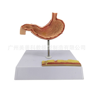Modelo gástrico patológico en miniatura; modelo gástrico patológico perforado del estómago humano; gastroenterología; coronal - Product Image 5