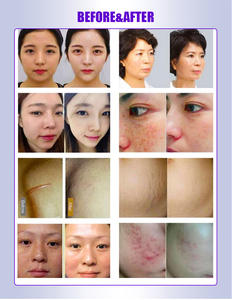 Meilleur <span class=keywords><strong>prix</strong></span> pour la machine à micro-aiguilles RF en or pour le lifting du visage et du corps, le raffermissement, l'élimination des rides et des cicatrices d'acné - Product Image 5