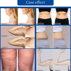 <span class=keywords><strong>Appareil</strong></span> de remodelage corporel par ondes froides <span class=keywords><strong>efficace</strong></span> pour lutter contre le vieillissement, améliorer le relâchement cutané et éliminer le double menton - Product Image 4
