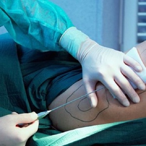    Máquina de Liposucción <span class=keywords><strong>Vaser</strong></span> de 980nm para Adelgazamiento, Máquina de Lipólisis Láser de 1470nm para Eliminación de Grasa, Máquina de Lipo Láser - Product Image 2