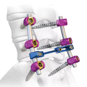 Medical Surgical <strong>Doctor</strong> Use Minimally Invasive Pedicle Screw Titanium System - Product Image 2