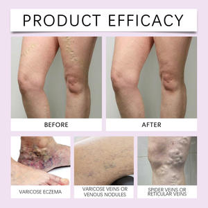 Relieves Legs Pain Smoothing and Moisturizing Skin Health Care <strong>Varicose</strong> <strong>Veins</strong> <strong>Treatment</strong> <strong>Cream</strong> - Product Image 4