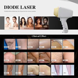 Máquina de Depilación Láser Nd Yag Q-Switched, <span class=keywords><strong>Precio</strong></span> de Láser de Diodo, Láser para Eliminación de Tatuajes - Product Image 5