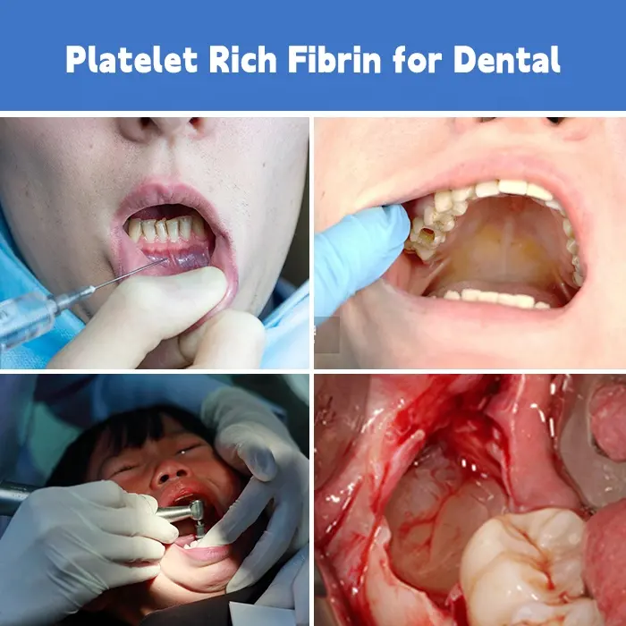 Oude Cgf Growh Factor Bloedplaatjesrijke Fibrine Prf Tubes 10Ml Voor Tanden Implantaat
