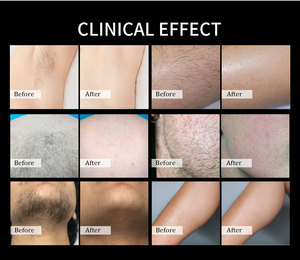 Mesin Penghilang Bulu <span class=keywords><strong>Laser</strong></span> <span class=keywords><strong>Diode</strong></span> Profesional Triple Wave 3D <span class=keywords><strong>Diode</strong></span> <span class=keywords><strong>Laser</strong></span> Ice 755 808 1064 yang Disetujui CE - Product Image 5