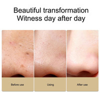 Microbulle rechargeable à main dissolvant de points noirs nettoyant pour la peau du visage nez et les pores traitement de l'acné appareil sous vide outil de soin de la peau