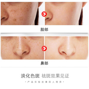 ครีมเคฟูซินไวท์เทนนิ่ง บริทเทนนิ่ง สปอต รีมูฟเวอร์ 30 กรัม สำหรับดูแลผิวหน้า - Product Image 2