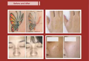 Ultra Picolris q Geschaltete NdYag Laser Tattoo entfernungs maschine Pico sekunden laser Pico Laser Tattoo Pigmenten tfernung Korea