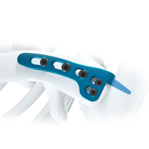 Canwell Titan xương đòn móc khóa tấm cho bị hỏng cổ áo xương chỉnh hình cấy ghép chấn thương gãy xương phẫu thuật cao cấp - Product Image 2