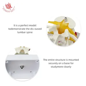 Modello di patologia della colonna lombare FRT038 Herniat disk modello patologico della Vertebra lombare umana - Product Image 2