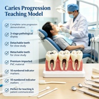 Modelo de Caries Dental de 3 Etapas, Ampliado 5 Veces, Dientes Desmontables para Educación en Patología Oral, CE ISO ROHS CNAS