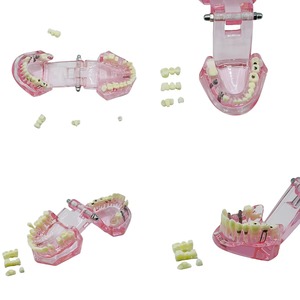 Modèle d'entraînement aux implants dentaires avec dents amovibles et démonstration de pathologie pour la pratique et l'enseignement de la restauration de ponts et de l'implantation dentaire, taille réelle - Product Image 3