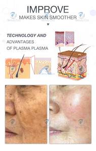 Nuevo Lápiz de Plasma Frío y Caliente Mejorado, Portátil, 2 en 1, para Reparación de la Piel del Rostro, Reafirmación, Lifting, Antienvejecimiento, Limpieza y Eliminación de Manchas - Product Image 4