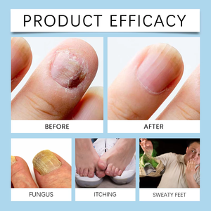 Suero para el Cuidado de las Uñas con Veneno de Abeja, Extracto Natural de Plantas, Repara Uñas Gruesas y Descoloridas, Disponible OEM - Product Image 3