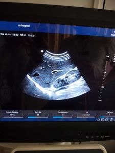 Zonecare <span class=keywords><strong>Ultrasound</strong></span> Perut Doppler Warna Lanjutan dengan Gambar Elastisitas - Product Image 6