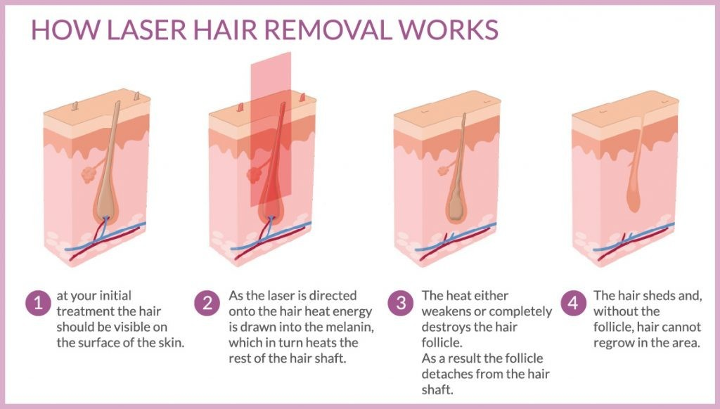 High Intensity 808nm Diode Laser Hair Removal Machine led 808