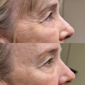 Buen <span class=keywords><strong>Precio</strong></span> HIiiFU 25d Madrid Ultrasonido Gel HIiiFU 11d 12d Hiiifu Manipulo Cartucho de Repuesto de 10000 Disparos Fabricante - Product Image 6