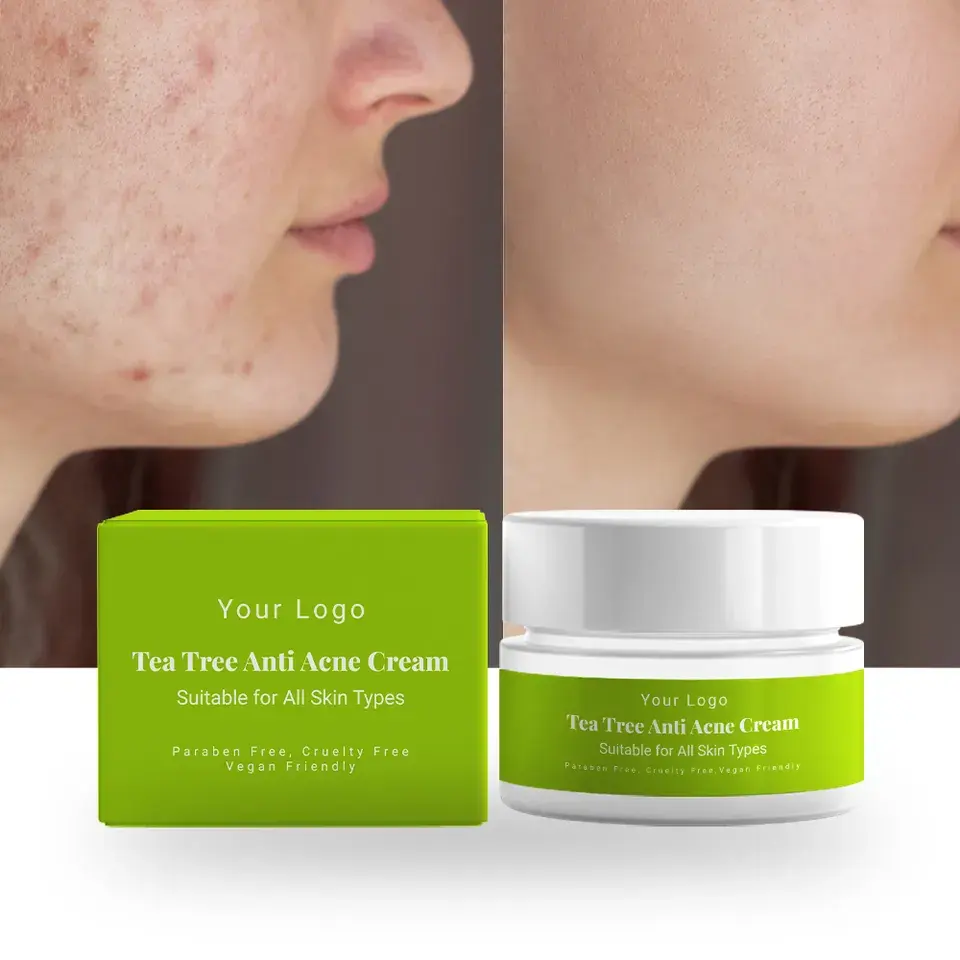 Fórmula personalizada Private Label Herbal Acne Spot Remover Anti Acne Face Cream Tratamento