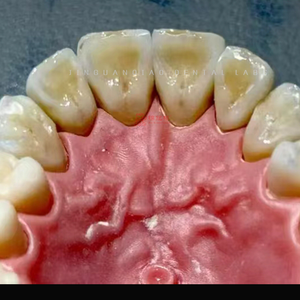 Dentiera denti finti fissi Zirconia denti corone & ponti laboratorio dentale cinese con la migliore qualità - Product Image 2