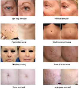 Laser fractionnel Co2 professionnel 10600nm avec sonde vaginale vergetures élimination des cicatrices resserrement de la peau traitement vaginal - Product Image 6