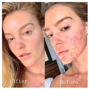 Suero BHA antiacné personalizado de fábrica para el cuidado de la piel <span class=keywords><strong>facial</strong></span>, tratamiento de manchas de acné, reparación, reducción de poros, Control de aceite, sueros faciales de ácido salicílico - Product Image 3