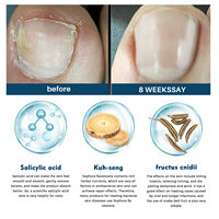 Crème anti-fongique pour les ongles, traitement de l'onychomycose, soin antifongique pour les pieds et les orteils, pommade anti-infection