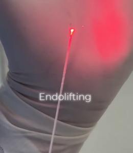 Dispositivo de Rejuvenecimiento Facial Endolaser Aprobado por la FDA de EE. UU., Lipólisis Corporal, Liposucción de Grasa, Máquina de Láser de Diodo de 980nm y 1470nm - Product Image 5