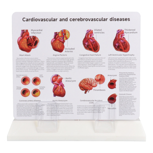Modelo Anatómico de <span class=keywords><strong>Arteriosclerosis</strong></span> de 4 Partes con Sección Transversal de Arteria, Modelo de Ciencia Médica para Enseñanza Médica a Pacientes y Doctores - Product Image 5