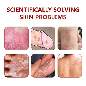 Pomada para coceira de tinea cruris (micoses da virilha) para homens e mulheres, creme de ervas chinesas para eczema, creme para dermatófitos, produtos em alta. - Product Image 5