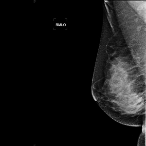 Y tế kỹ thuật số mammography x Ray thiết bị 5KW xách tay kỹ thuật số DR mammography giá máy - Product Image 6