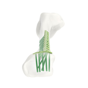 Placa de bloqueo pediátrica de alto rendimiento para implantes de fractura al por mayor, 5.0mm, para usar con tornillo cortical autorroscante de bloqueo 5.0 - Product Image 2