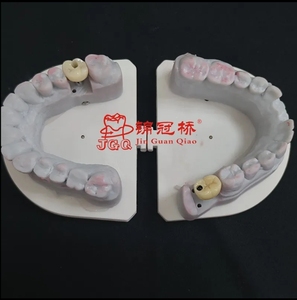 ส่วนบนของฟันเทียมไทเทเนียมพิมพ์ดิจิตอล3D แบบกำหนดเองเหมาะสำหรับระบบฝังหลัก - Product Image 3