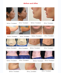 Appareil de remodelage corporel RF monopolaire 10-en-1 pour la réduction de la graisse, le raffermissement de la peau et le lifting facial - Product Image 5