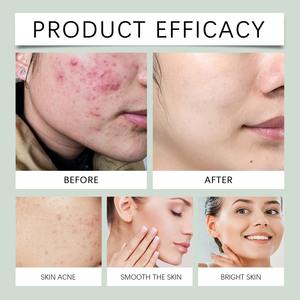 Nettoyant Visage Personnalisé à l'Arbre à Thé Anti-Acné 100g – Nettoyage en Profondeur, Contrôle du Sébum, Idéal Peaux Grasses et à Tendance Acnéique, Usage Quotidien - Product Image 2