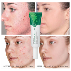 Crème à l'<span class=keywords><strong>aloe</strong></span> <span class=keywords><strong>vera</strong></span> pour l'acné en stock, 20g, produits de soin de la peau hydratants, gel anti-acné - Product Image 6