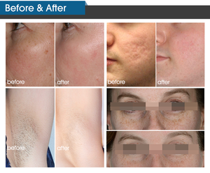 ADSS E Light OPT динамический импульсный свет IPL машина для удаления волос для омоложения кожи и удаления волос - Product Image 6