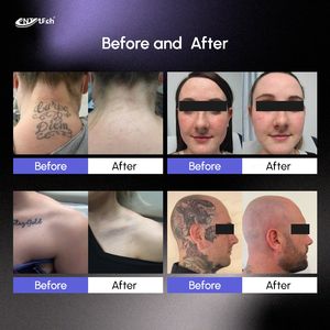 Máquina Láser NdYag Q-Switch Portátil UNTTECH para Eliminación de Pigmentos de Tatuajes, Uso Comercial, Multi-Longitud de Onda - Product Image 6