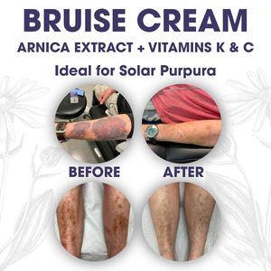Private Label Natural Arnica <strong>Bruise</strong> <strong>Cream</strong> <strong>for</strong> Thin Skin - Moisturizing, Vitamin K C and E, Skin Renewal - Product Image 5