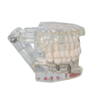Modèle dentaire transparent d'implant dentaire, modèle de restauration de couronne et de pont amovible pour la démonstration pédagogique des dentistes