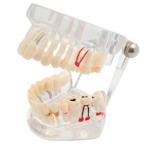 <span class=keywords><strong>Prix</strong></span> usine Transparent <span class=keywords><strong>adulte</strong></span> pathologie dentaire dents modèle prothèse modèle d'enseignement modèle dents - Product Image 2