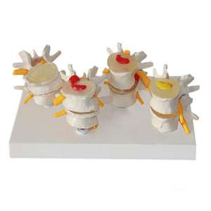 Gelsonlab HSBM-134 4 Stadiumwervels Menselijk Anatomisch Model Lendenwervel Wervel Zieke Osteoporose Wervels Model - Product Image 4