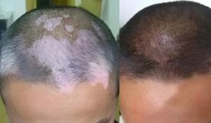 Appareil de thérapie du vitiligo portable KN-4003BL de haute qualité, UVB, bande étroite 311 nm, lampe de guérison UVB - Product Image 6