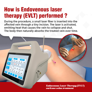 Láser de diodo de 980nm y 1470nm para coagulación venosa EVLT/EVLA, ablación médica intravenosa para venas varicosas en las <span class=keywords><strong>piernas</strong></span> - Product Image 5