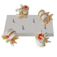 Modelo de Comparación de Degeneración de Vértebras Lumbares en 4 Etapas, Modelo de Anatomía de Columna Vertebral con Gráfico Anatómico