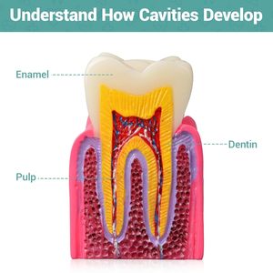 Modèle de démonstration de caries dentaires, modèle d'enseignement de l'anatomie dentaire pour l'éducation et l'explication aux patients - Product Image 4
