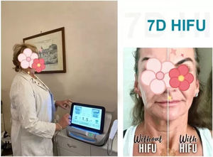 Nouveau Modèle 2026 <span class=keywords><strong>Professionnel</strong></span> 7D SMAS Lifting 7 Cartouches HIFU 7D Facial et Corporel pour Raffermissement de la Peau et Brosse Nettoyante Amincissante - Product Image 2