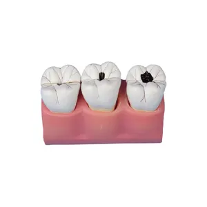 50108.07 نموذج متدرج للأسنان المتحللة