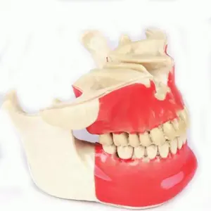 凹形骨材料牙种植牙模型M2031